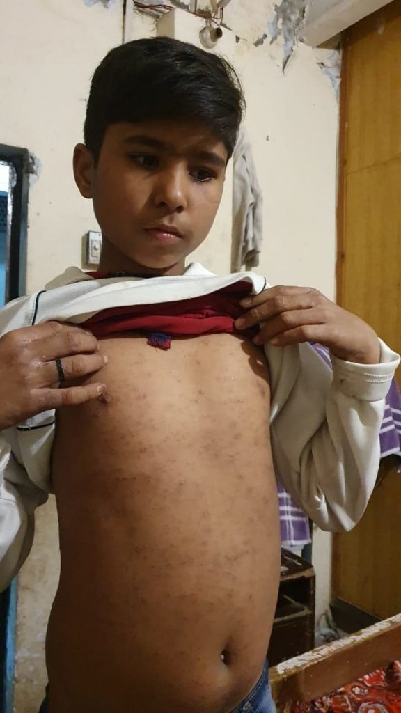 Orphaned Children of Shama and Shahzad (burned alive in 2014 by Muslim mob) have bed bugs and collapsing beds